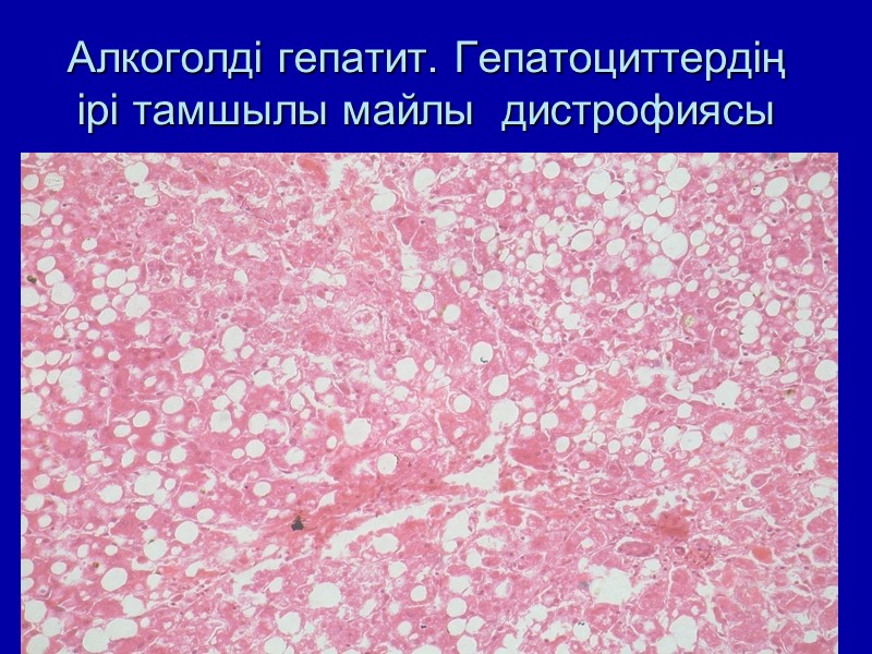 Алкоголді гепатит. Гепатоциттердің ірі тамшылы майлы  дистрофиясы